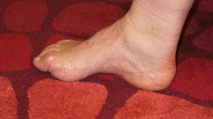 My right foot showing pes cavus (high arch) and hammer toes